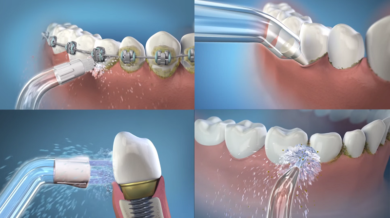 Máy tăm nước giúp vệ sinh răng sạch sẽ